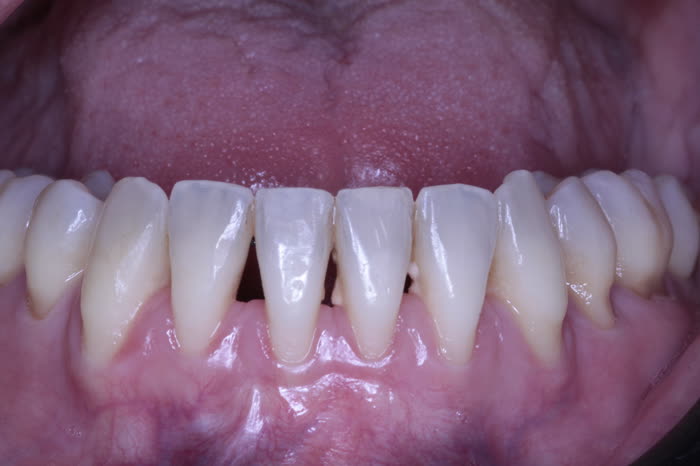 Situación inicial con recesiones gingivales